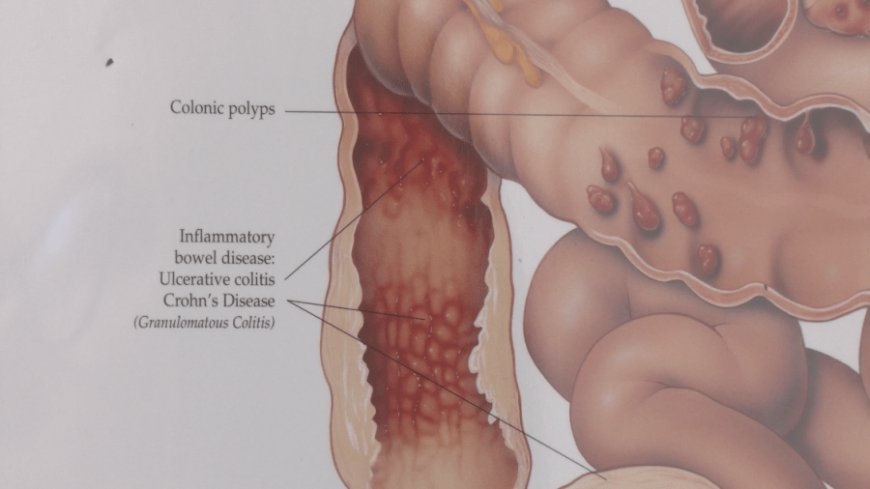 Crohn's and Colitis Awareness Week highlights symptoms and treatment options